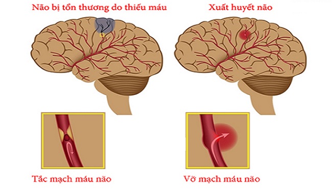Các phương pháp điều trị tai biến mạch máu não