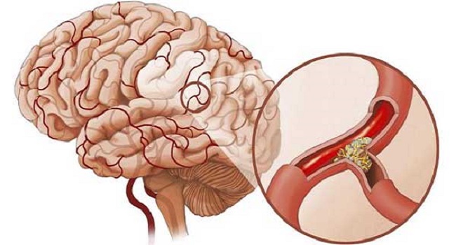 Cách điều trị tai biến mạch máu não